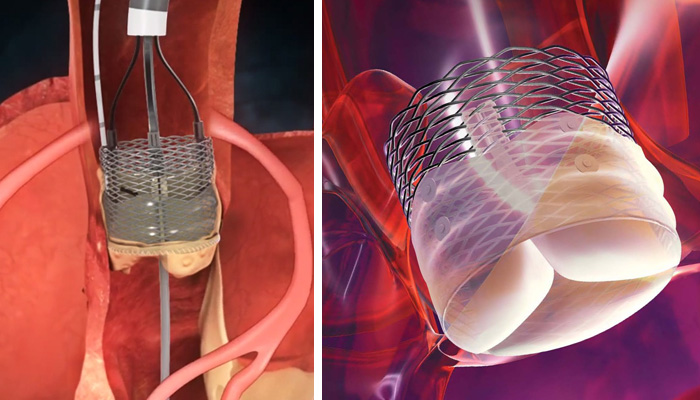 Lexington Medical Center Performs First-of-its-Kind Heart Valve Replacement in South Carolina