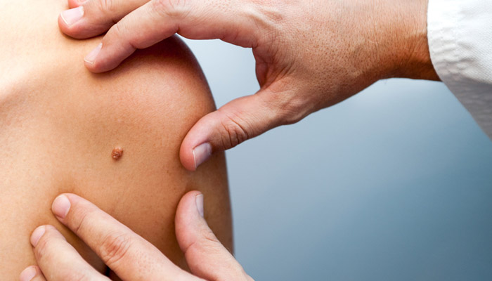 FREE Skin Cancer Screening